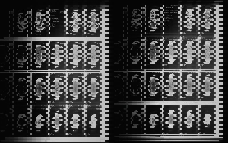 CAT scan imaging data from the National Cancer Institute