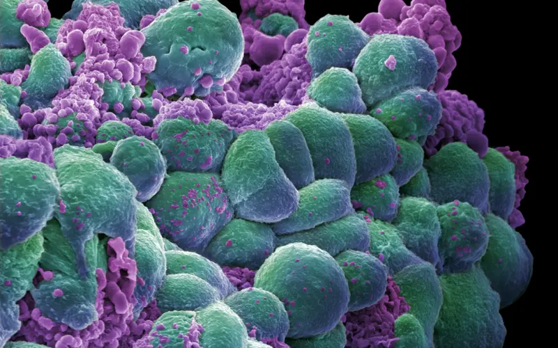 Breast Cancer Cells 2